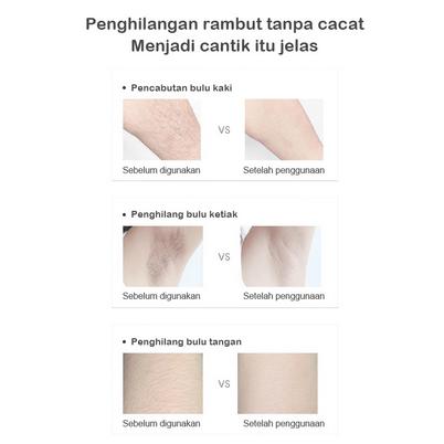 Ice Cold IPL Hair Removal Device – 1 Million Shots